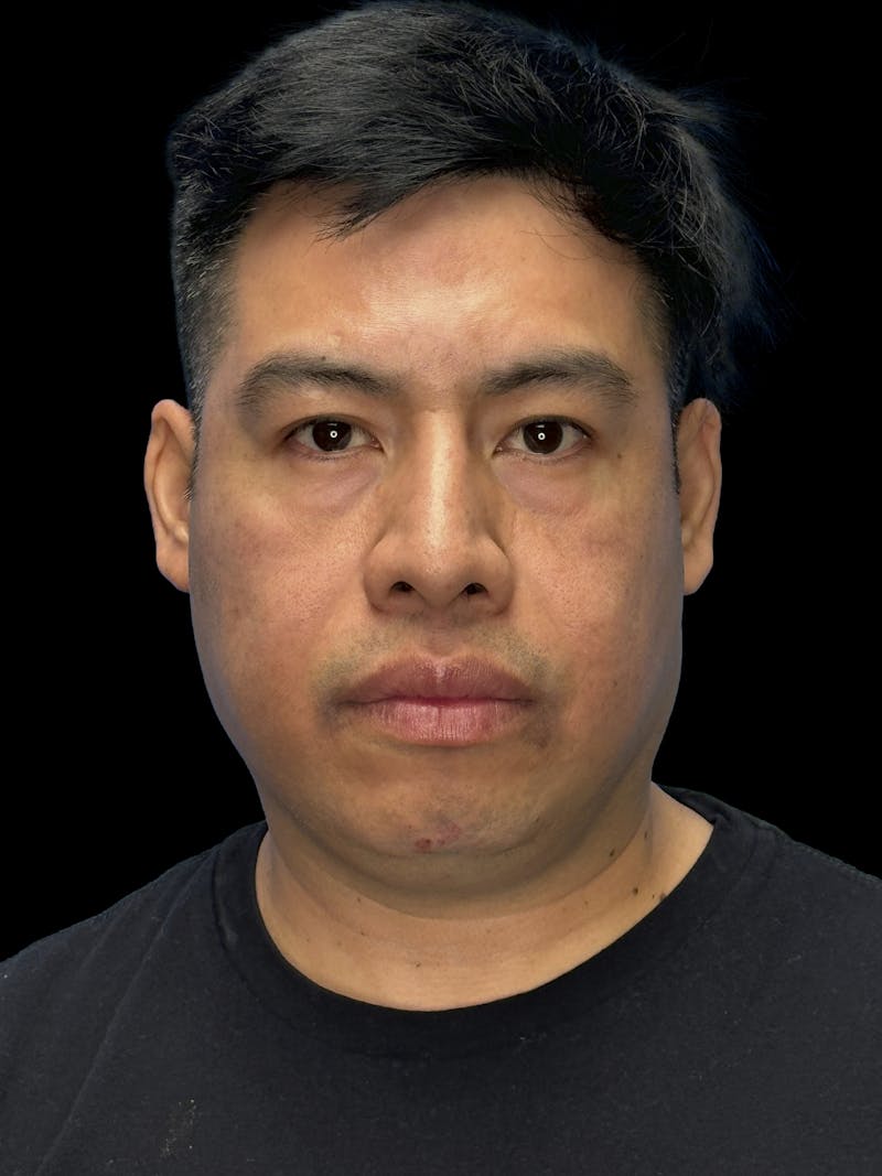 Chin Implant Before & After Gallery - Patient 375006 - Image 1