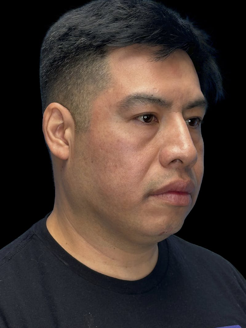 Chin Implant Before & After Gallery - Patient 375006 - Image 7
