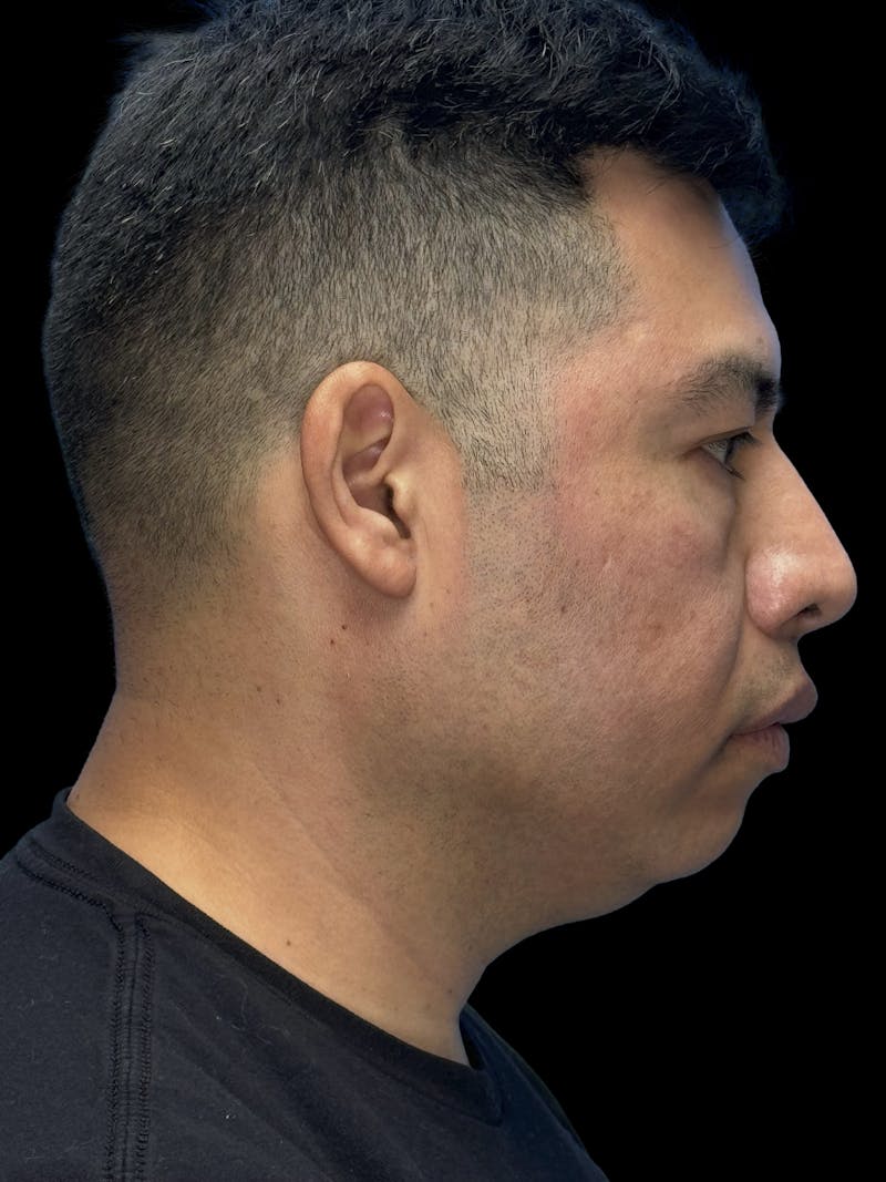 Chin Implant Before & After Gallery - Patient 375006 - Image 9