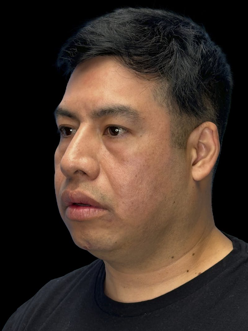 Chin Implant Before & After Gallery - Patient 375006 - Image 3