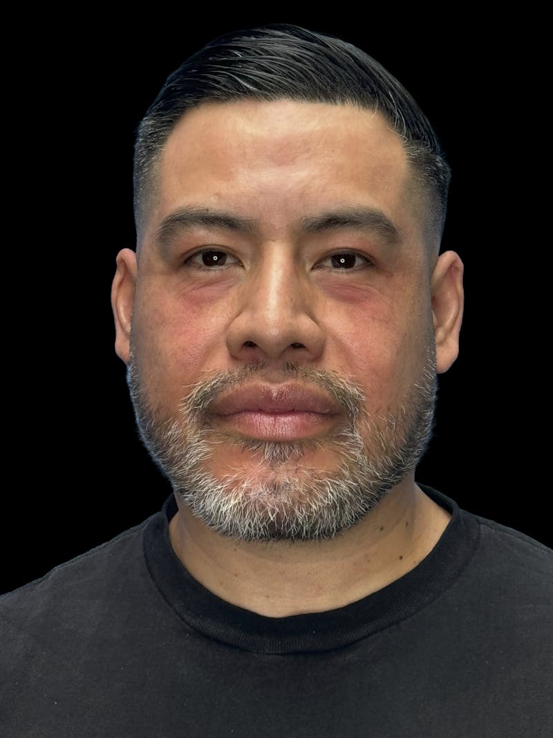 Chin Implant Before & After Gallery - Patient 375006 - Image 2