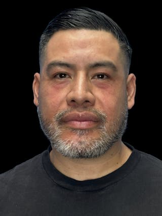 Chin Implant Before & After Gallery - Patient 375006 - Image 2