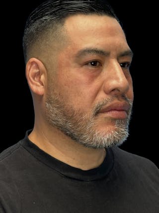 Chin Implant Before & After Gallery - Patient 375006 - Image 8