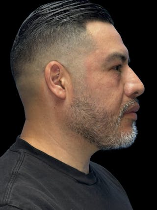 Chin Implant Before & After Gallery - Patient 375006 - Image 10