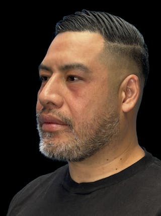 Chin Implant Before & After Gallery - Patient 375006 - Image 4