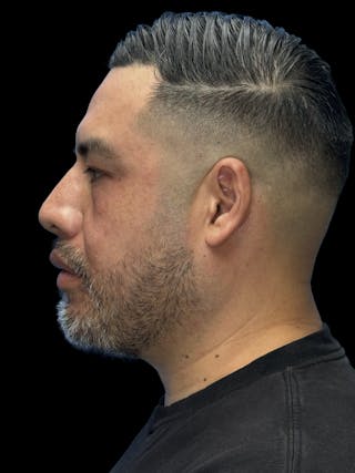 Chin Implant Before & After Gallery - Patient 375006 - Image 6