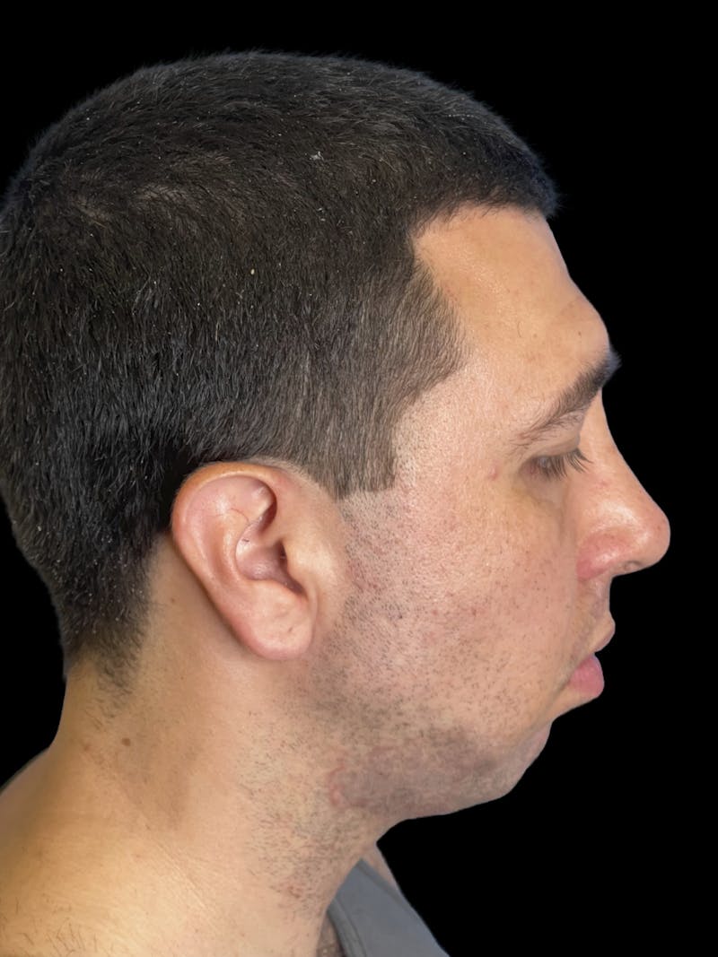 Chin Implant Before & After Gallery - Patient 709517 - Image 3