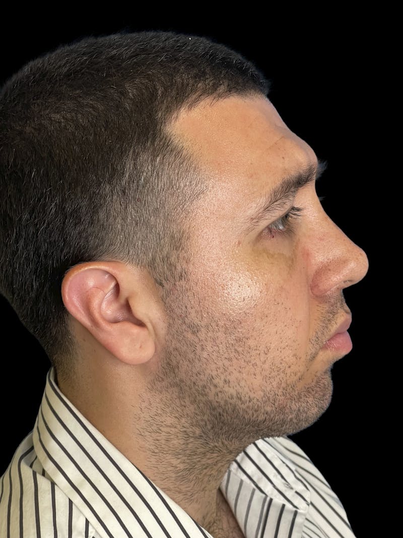 Chin Implant Before & After Gallery - Patient 709517 - Image 4