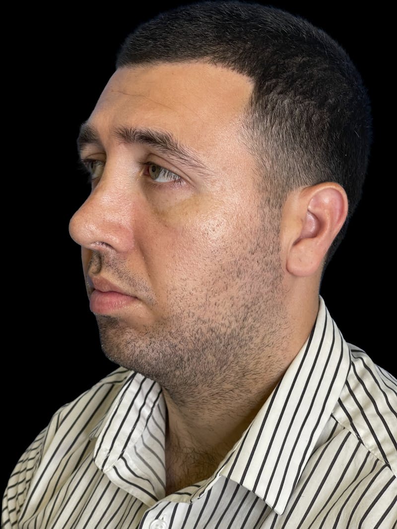 Chin Implant Before & After Gallery - Patient 709517 - Image 6