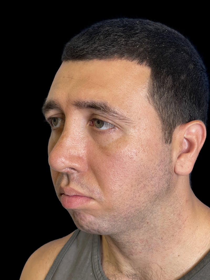 Chin Implant Before & After Gallery - Patient 709517 - Image 5