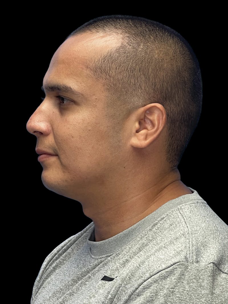 Chin Implant Before & After Gallery - Patient 305741 - Image 10