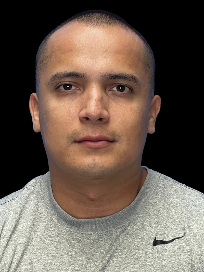 Chin Implant Before & After Gallery - Patient 305741 - Image 2
