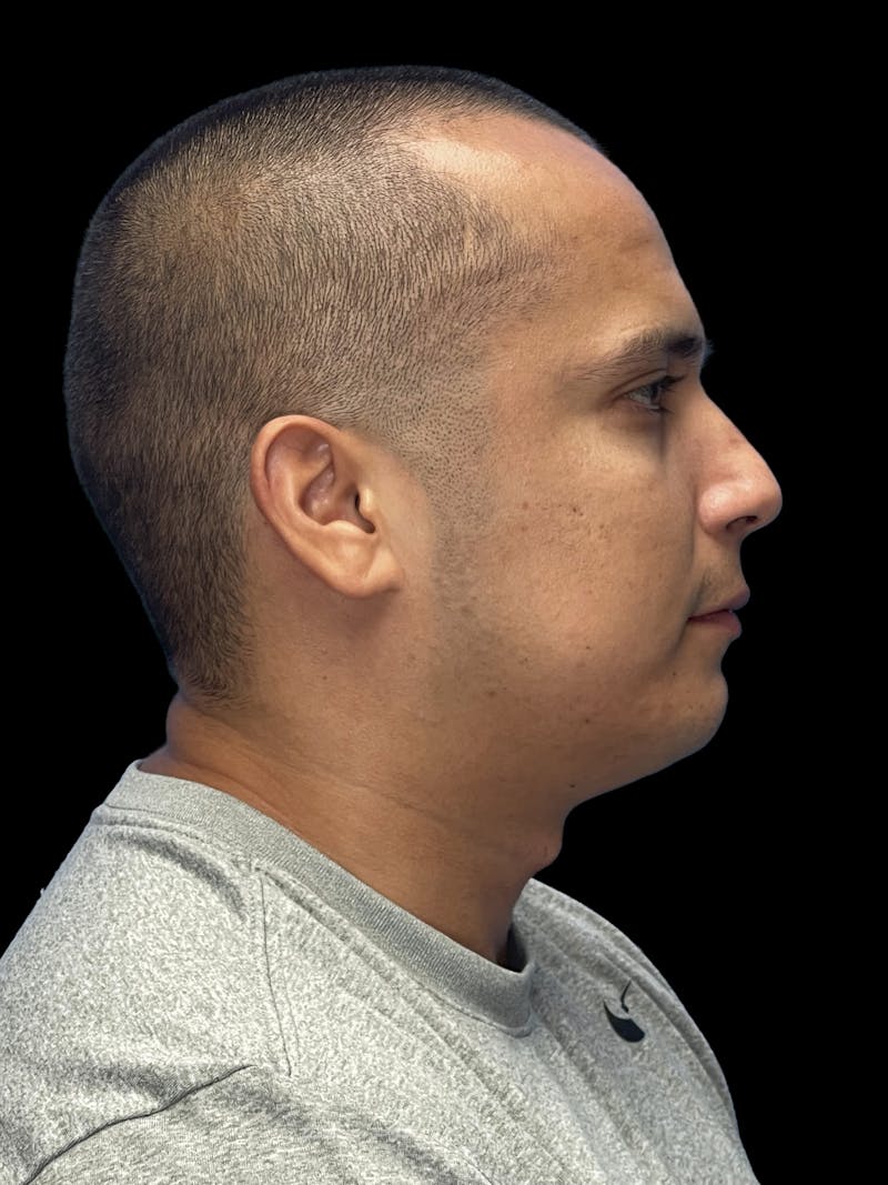 Chin Implant Before & After Gallery - Patient 305741 - Image 8