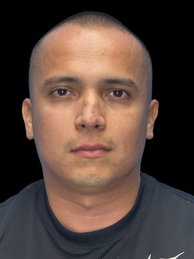 Chin Implant Before & After Gallery - Patient 305741 - Image 1