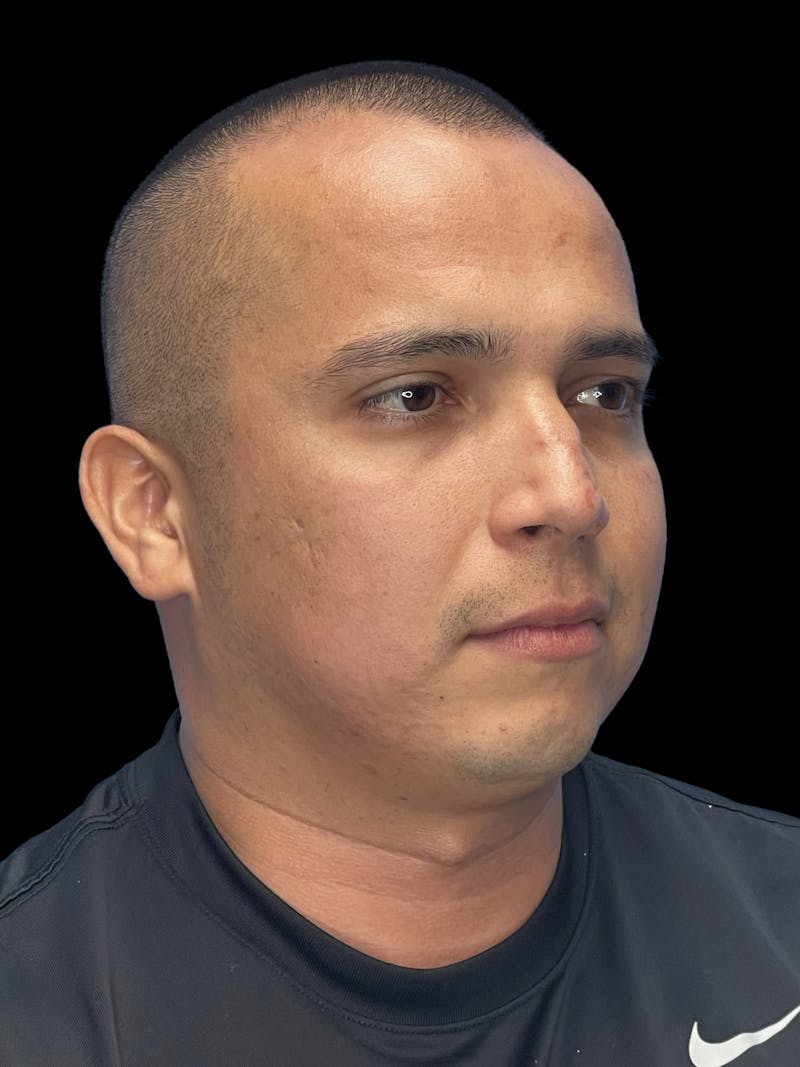 Chin Implant Before & After Gallery - Patient 305741 - Image 5