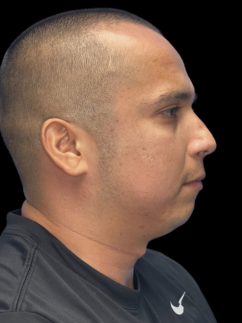 Chin Implant Before & After Gallery - Patient 305741 - Image 7