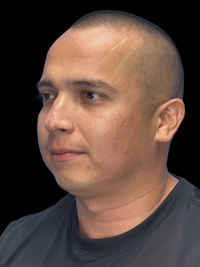 Chin Implant Before & After Gallery - Patient 305741 - Image 3