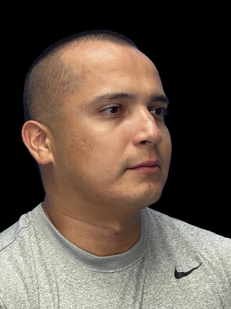 Chin Implant Before & After Gallery - Patient 305741 - Image 6