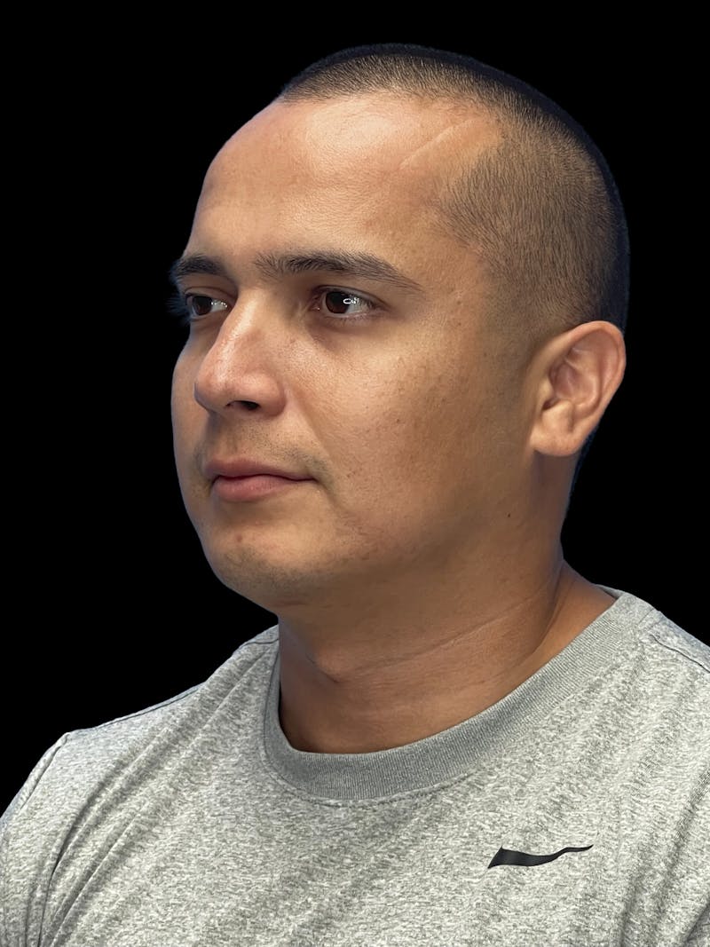 Chin Implant Before & After Gallery - Patient 305741 - Image 4