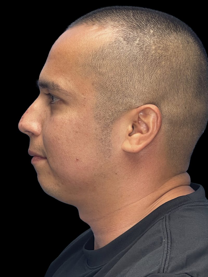Chin Implant Before & After Gallery - Patient 305741 - Image 9