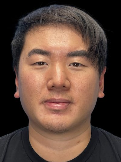 Chin Implant Before & After Gallery - Patient 113669 - Image 2