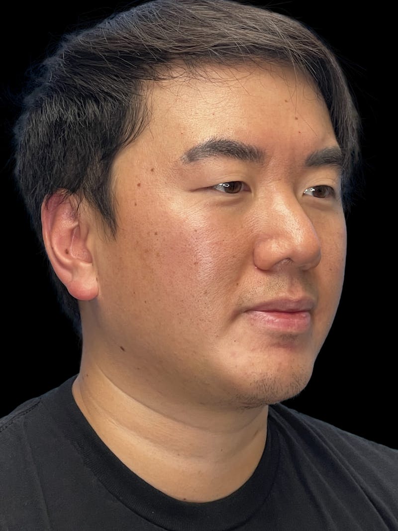 Chin Implant Before & After Gallery - Patient 113669 - Image 6