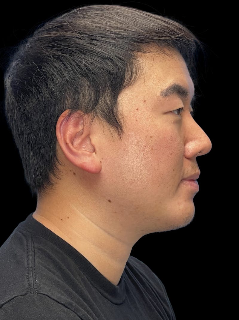 Chin Implant Before & After Gallery - Patient 113669 - Image 4