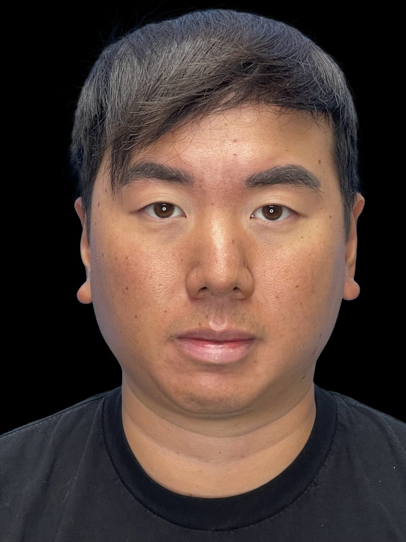 Chin Implant Before & After Gallery - Patient 113669 - Image 1