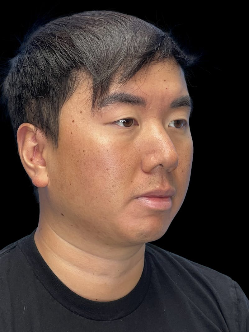 Chin Implant Before & After Gallery - Patient 113669 - Image 5
