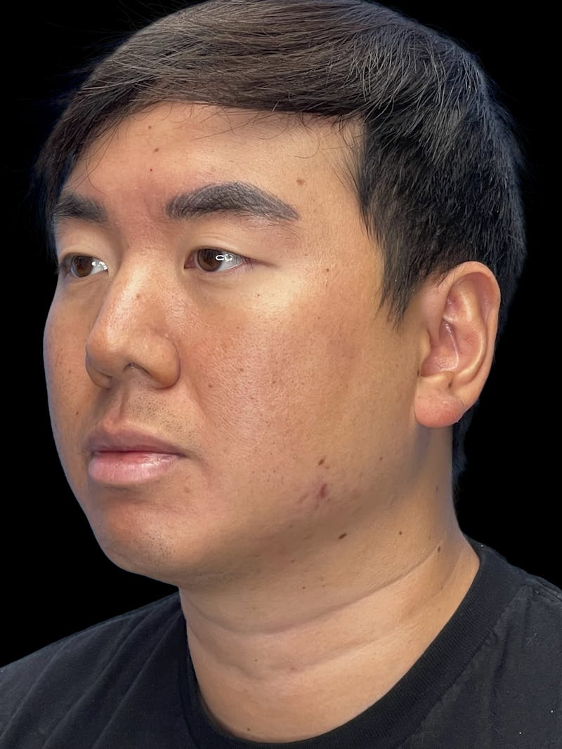 Chin Implant Before & After Gallery - Patient 113669 - Image 7