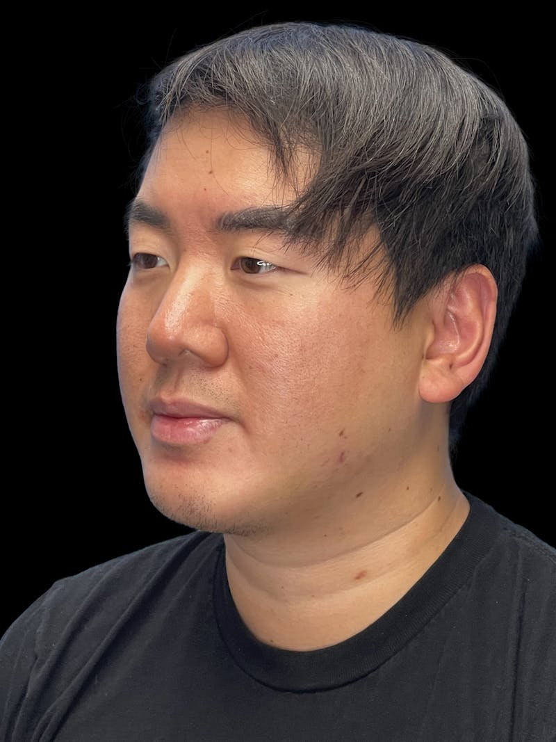 Chin Implant Before & After Gallery - Patient 113669 - Image 8