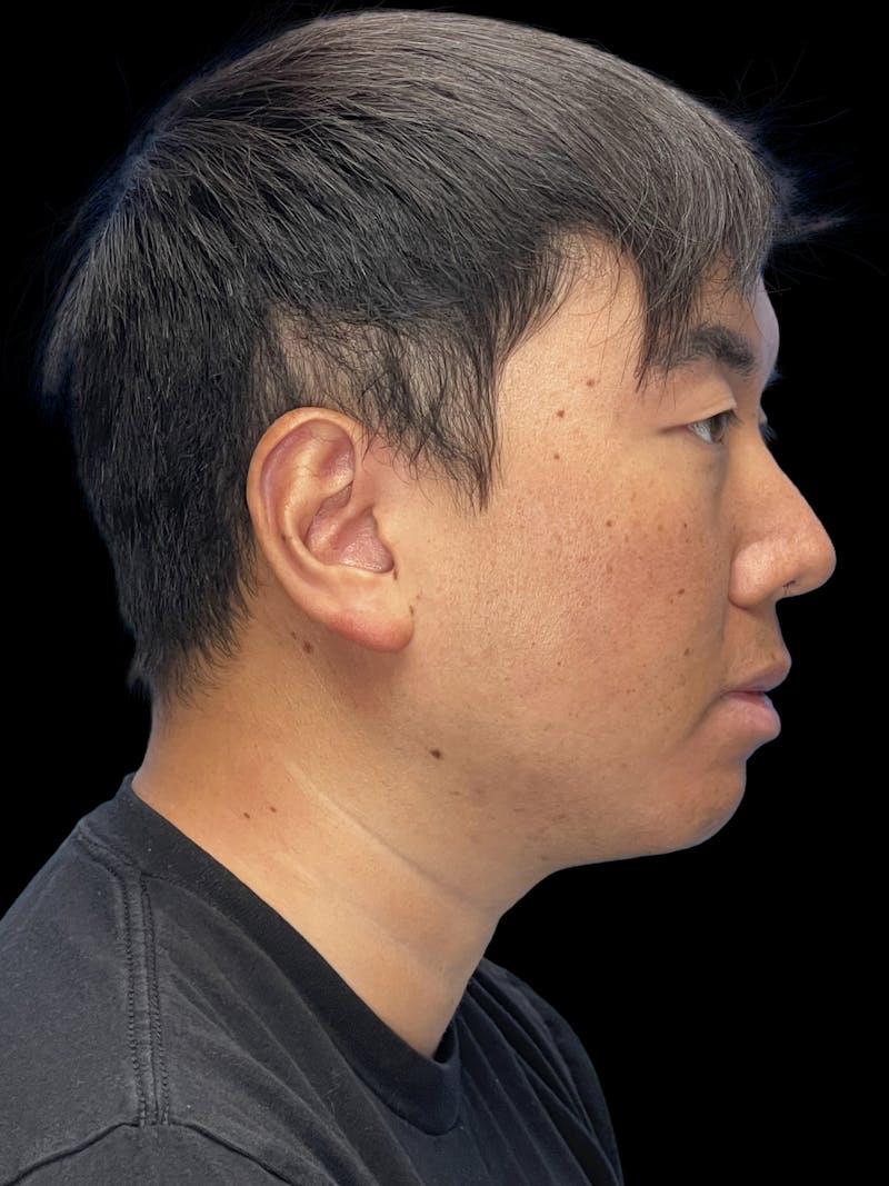 Chin Implant Before & After Gallery - Patient 113669 - Image 3