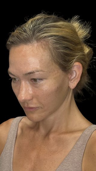 Cheek Implant Before & After Gallery - Patient 236191 - Image 4