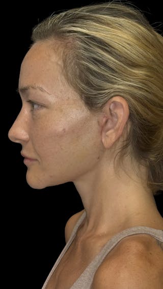 Cheek Implant Before & After Gallery - Patient 236191 - Image 6