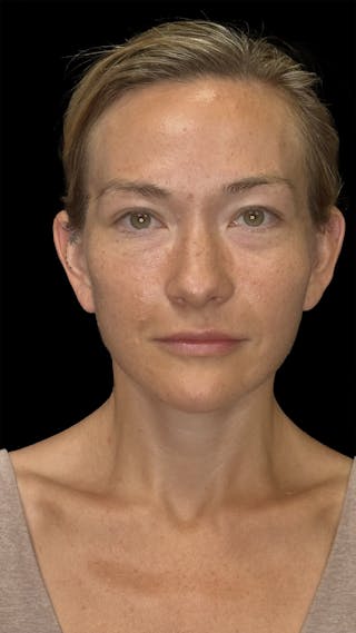 Cheek Implant Before & After Gallery - Patient 236191 - Image 2