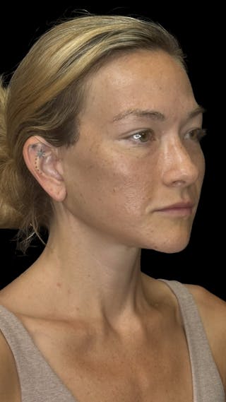 Cheek Implant Before & After Gallery - Patient 236191 - Image 12