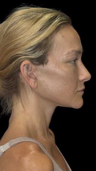Cheek Implant Before & After Gallery - Patient 236191 - Image 10