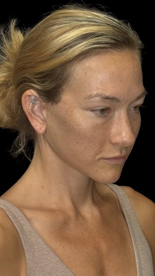 Cheek Implant Before & After Gallery - Patient 236191 - Image 8