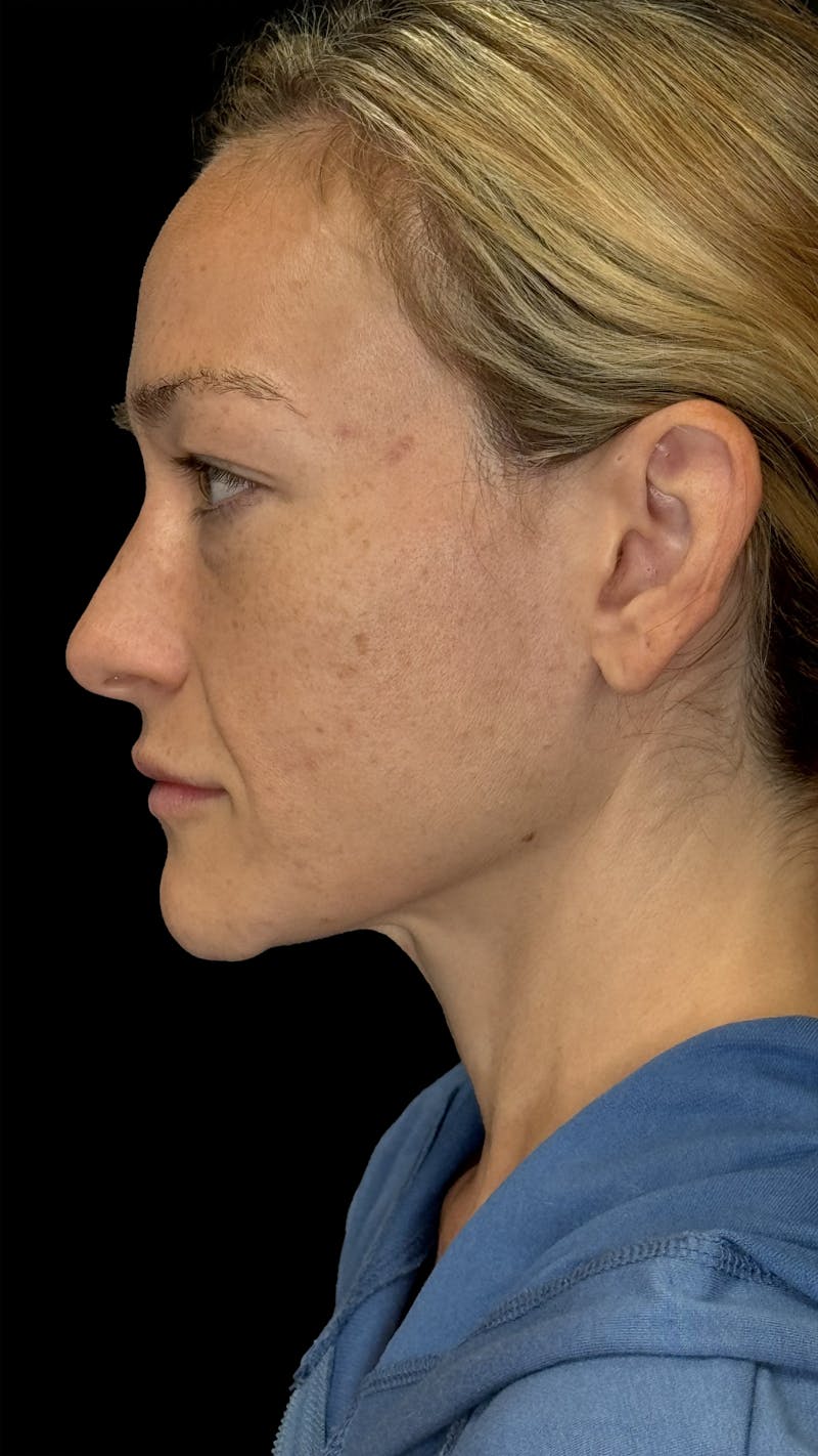 Cheek Implant Before & After Gallery - Patient 236191 - Image 5