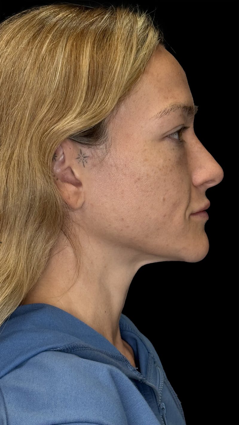 Cheek Implant Before & After Gallery - Patient 236191 - Image 9