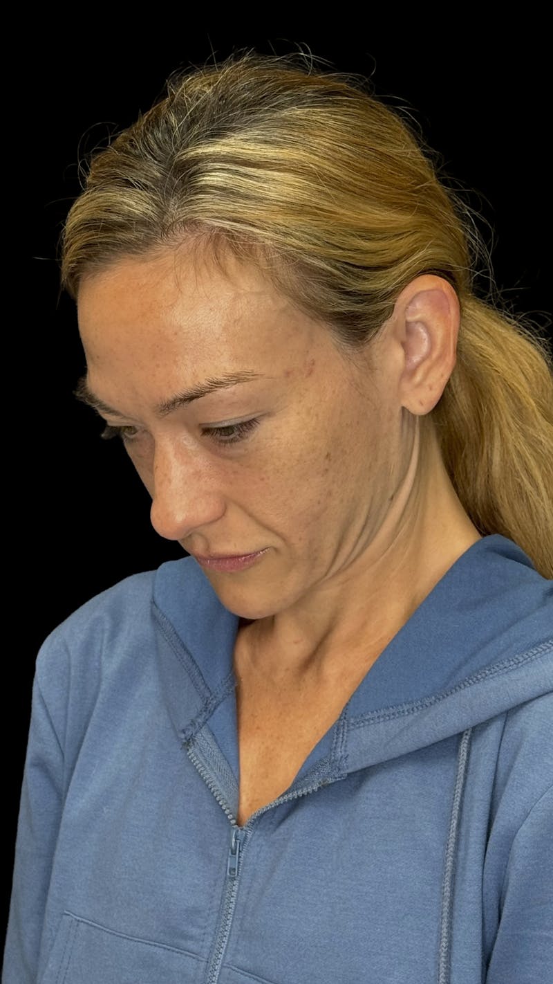 Cheek Implant Before & After Gallery - Patient 236191 - Image 3