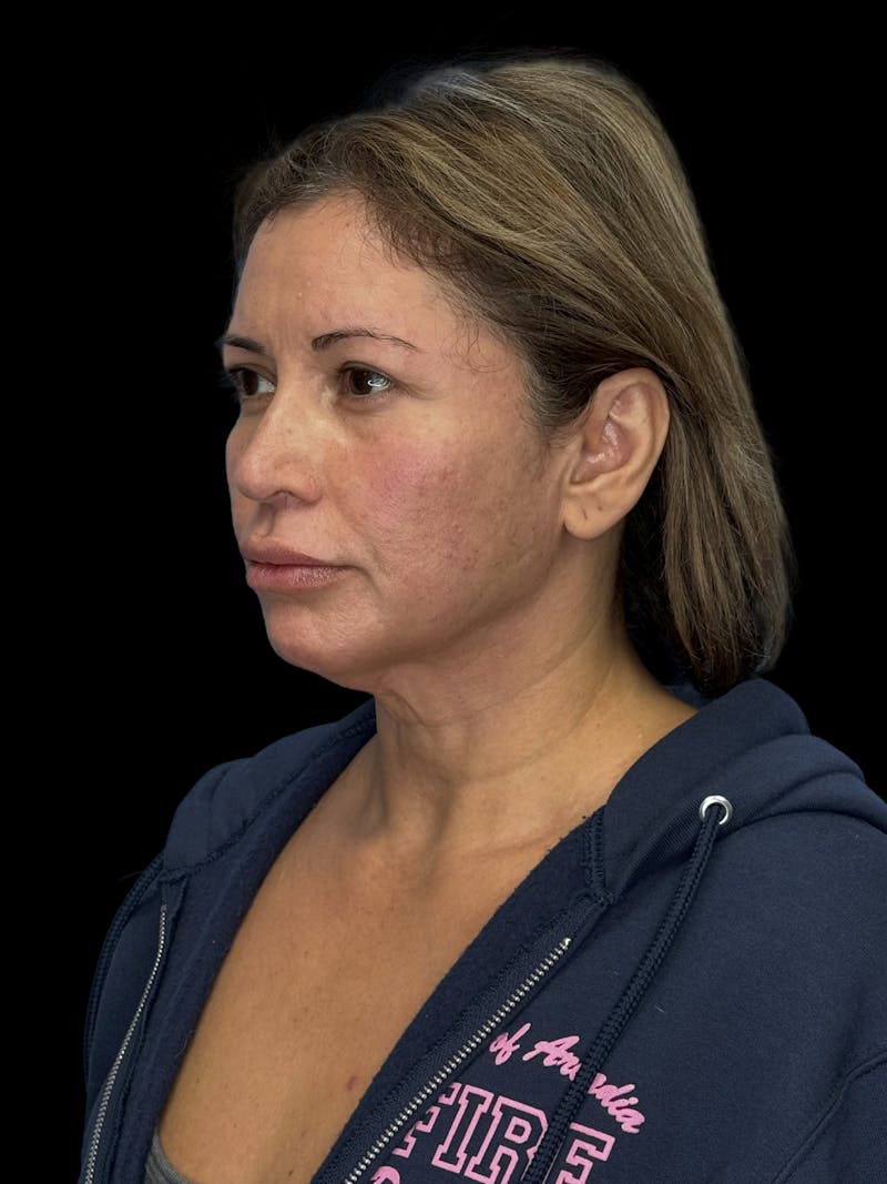 Brow Lift Before & After Gallery - Patient 298136 - Image 5