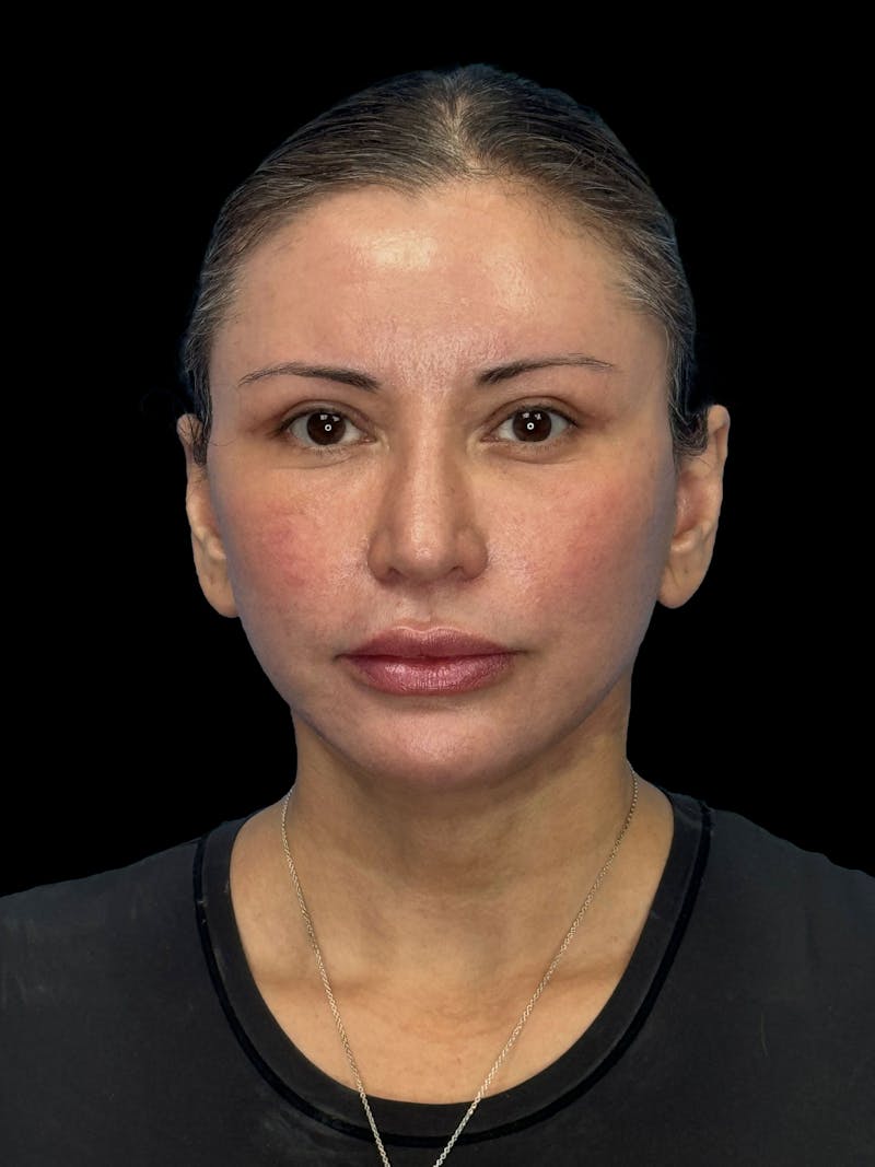 Brow Lift Before & After Gallery - Patient 298136 - Image 2