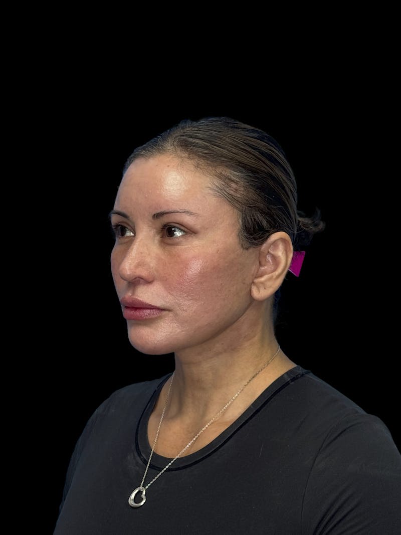 Brow Lift Before & After Gallery - Patient 298136 - Image 6