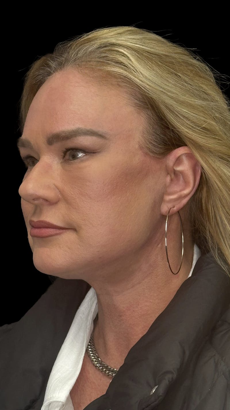 Brow Lift Before & After Gallery - Patient 380555 - Image 6