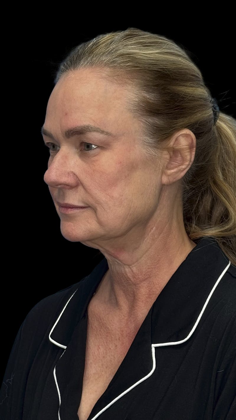 Brow Lift Before & After Gallery - Patient 380555 - Image 5