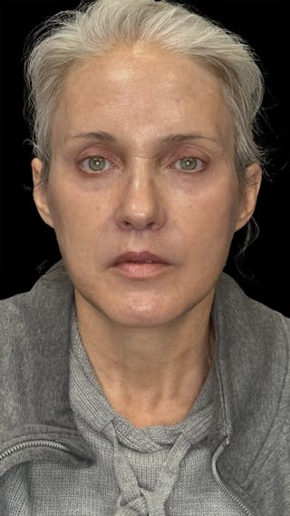 Brow Lift Before & After Gallery - Patient 155754 - Image 2