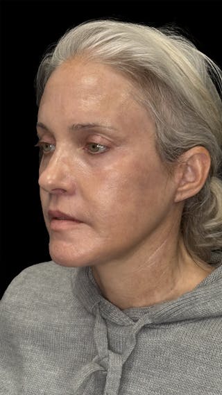 Brow Lift Before & After Gallery - Patient 155754 - Image 4