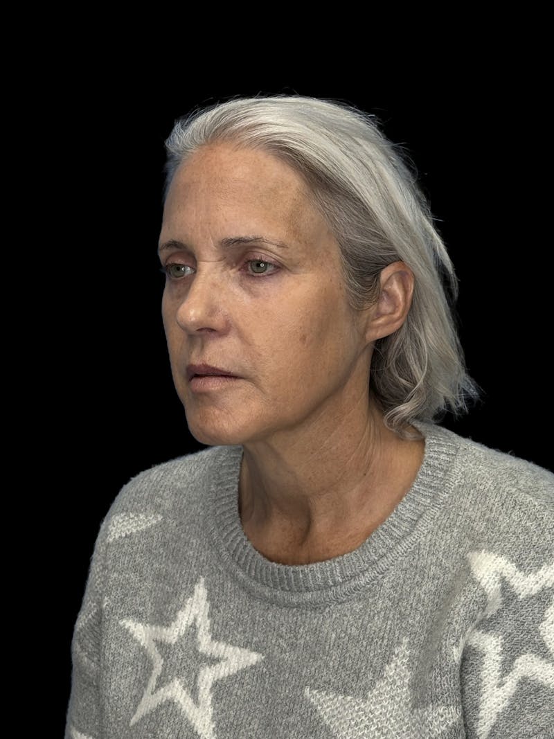 Brow Lift Before & After Gallery - Patient 155754 - Image 3