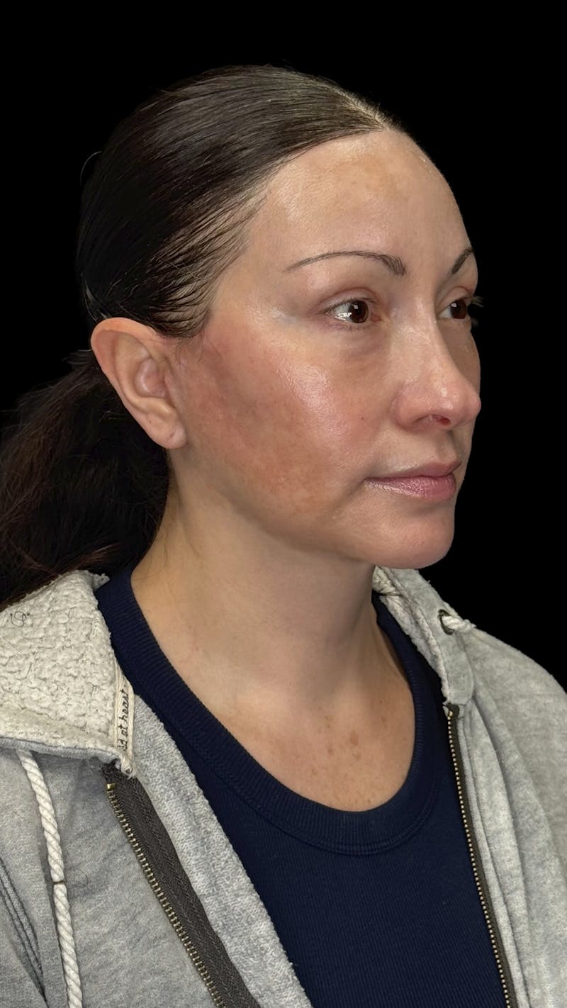 Brow Lift Before & After Gallery - Patient 231047 - Image 3
